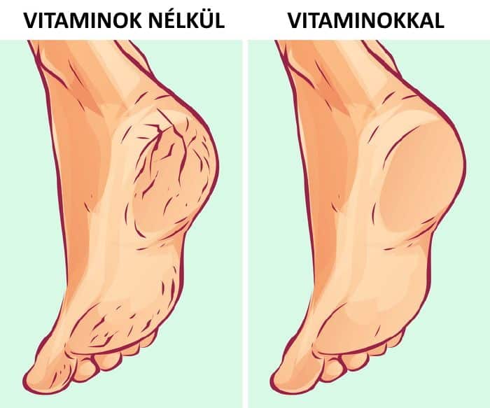 repedezett sarok okai kezelése ápolása6