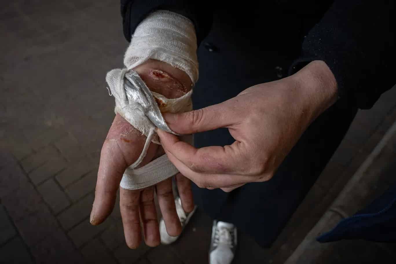 Andrei megmutatja a kezén és a karján ejtett sebeket, amelyeket több napig tartó megkötözés és verés okoz / Fotó: Bel Trew