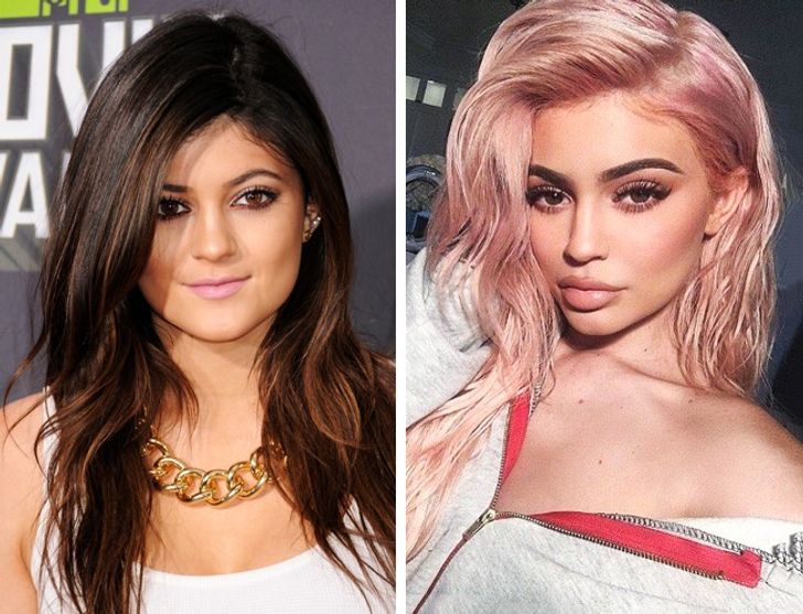 hiressegek plasztikai mutet Kylie Jenner