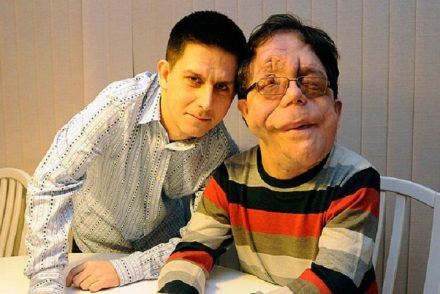 A brit ikerpár igazi inspiráció az embereknek: Adam és Neil Pearson története