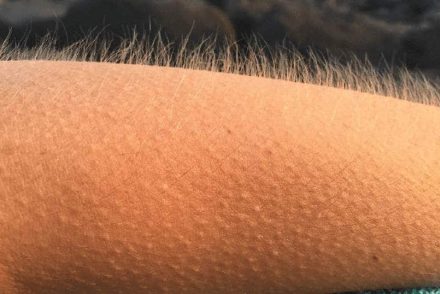 Tudósok feltárták a libabőr valódi okát