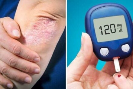 Jelek, amik talán fel sem tűnnek: a 2-es típusú cukorbetegség tünetei