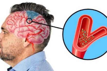 6 figyelmeztető jel, hogy közeleg a stroke
