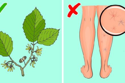 8 természetes mód a pókhálóvénák és a visszerek kezelésére