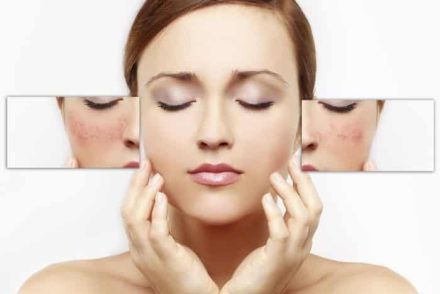Hatékony otthoni gyógymódok rosacea kezelésére