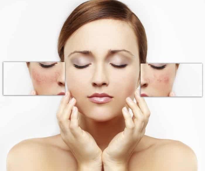 rosacea kezelése rosacea otthoni gyógymódok hatékony egészség életmód életmód tippek