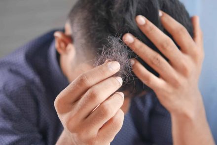 Egy férfi meglepő módszernek tulajdonítja, hogy megállt a hajhullása