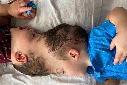 27 órás műtéttel sikeresen szétválasztották az agyuknál összenőtt sziámi ikreket