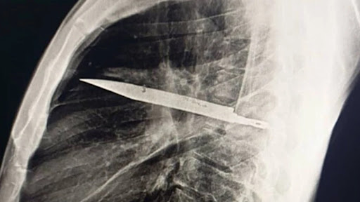 rontgen mellkas kes orvosi muhiba